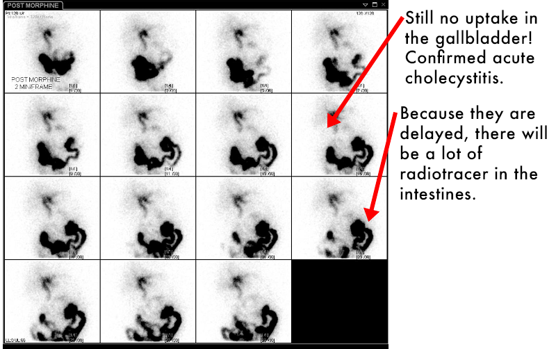 Acute cholecystitis